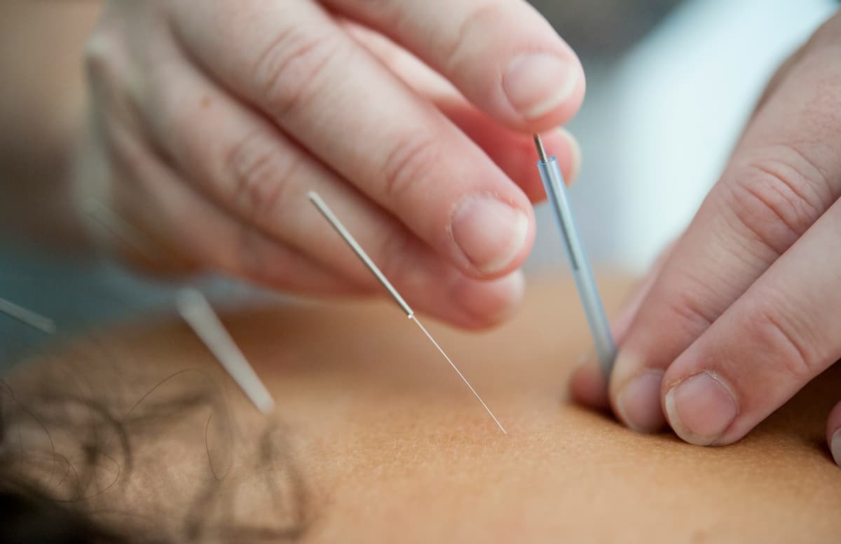 Servicio Acupuntura