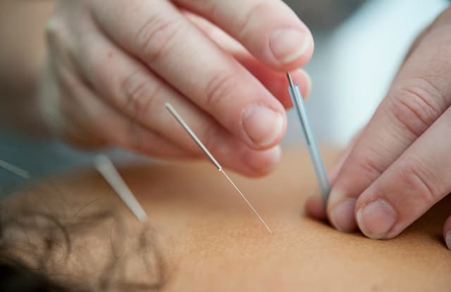 Servicio Acupuntura